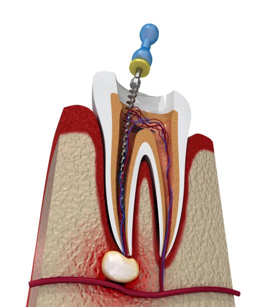 Root Canal Treatment
